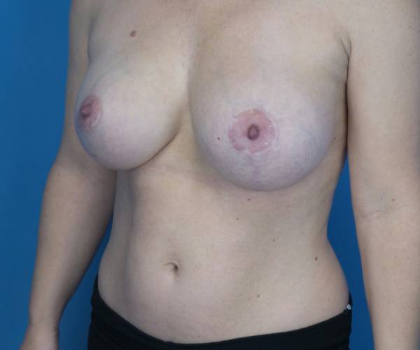 after breast lift with augmentation left angled view case 3294