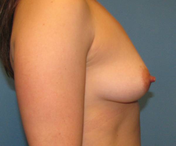 before breast lift with augmentation right side view case 3305