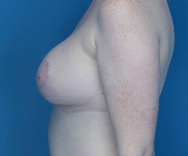 after breast lift with augmentation left side view case 3310