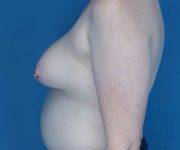 before breast lift with augmentation left side view case 3310