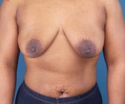 before breast lift with augmentation front view case 3320