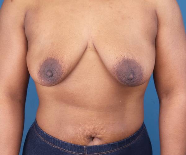 before breast lift with augmentation front view case 3320