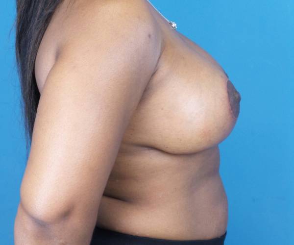after breast lift with augmentation right side view case 3320