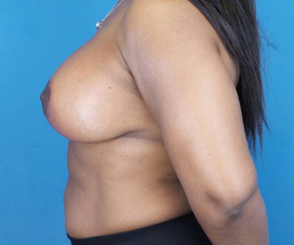 after breast lift with augmentation left side view case 3320