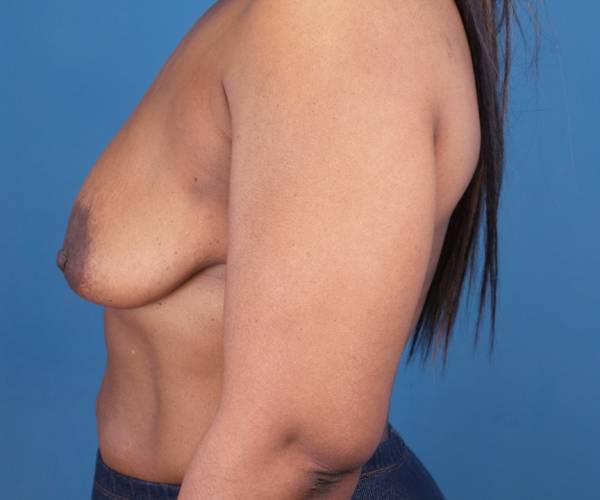 before breast lift with augmentation left side view case 3320