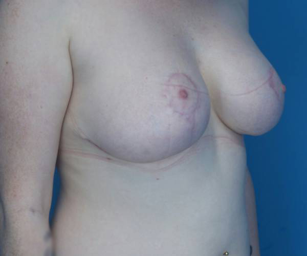 after breast lift with implants right angled view case 3310