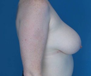 before breast lift with implants right side view case 3310