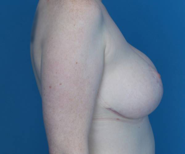 after breast lift with implants right side view cases 3310