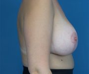 after breast lift with augmentation right side view case 3884