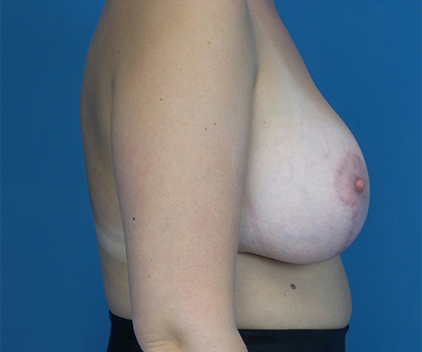 after breast lift with augmentation right side view case 3884