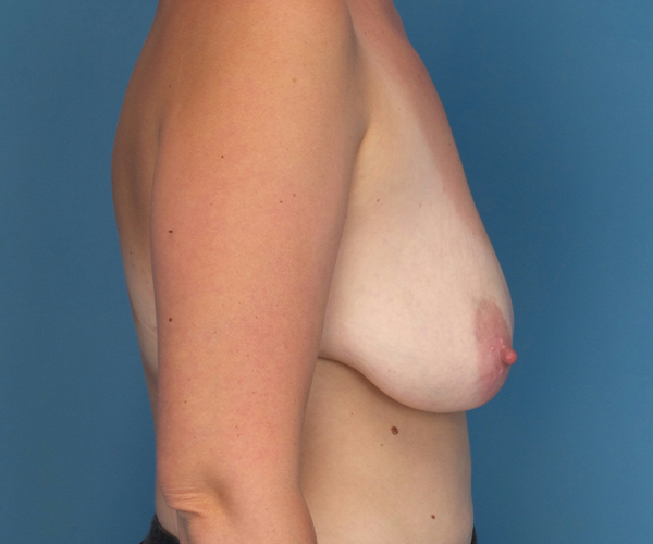 before breast lift with augmentation right side view case 3884