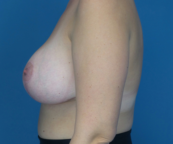 after breast lift with augmentation left side view case 3884