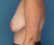 before breast lift with augmentation left side view case 3884