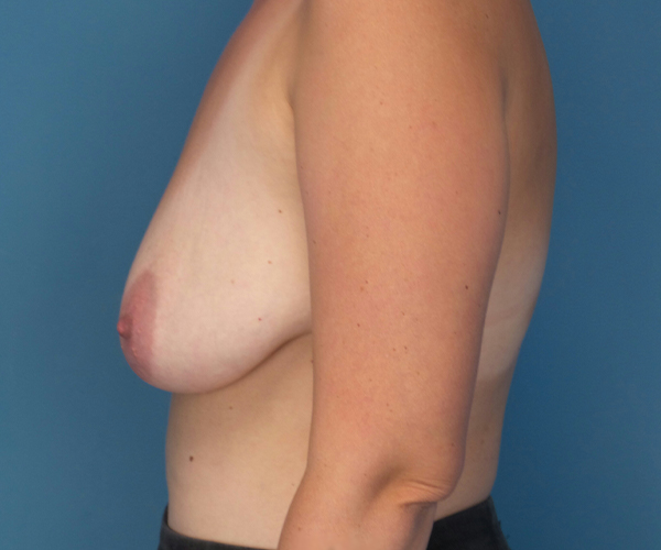before breast lift with augmentation left side view case 3884