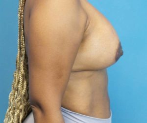after breast lift with augmentation right side view case 3891