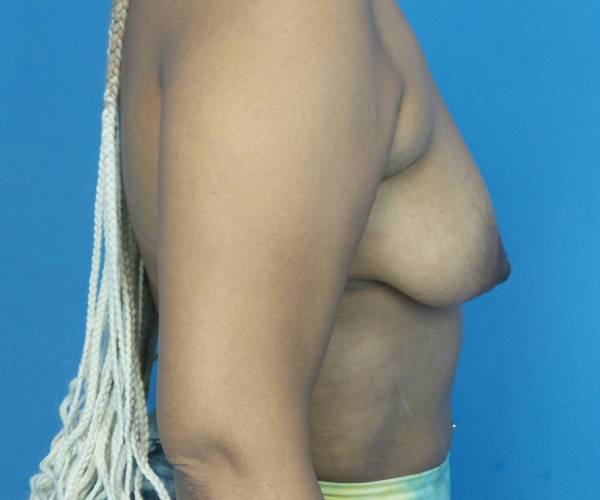 before breast lift with augmentation right side view case 3891