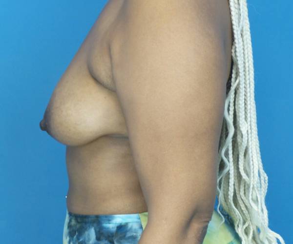 before breast lift with augmentation left side view case 3891
