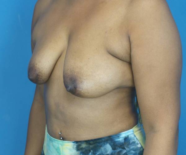 before breast lift with augmentation left angled view case 3891