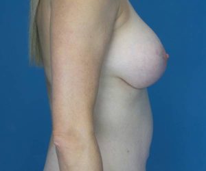 after breast lift with augmentation right side view case 3907