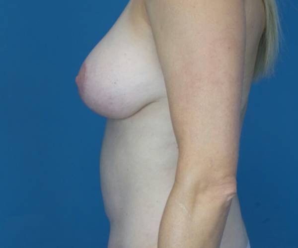 after breast lift with augmentation left side view case 3907