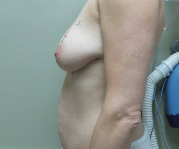 before breast lift with augmentation left side view case 3907