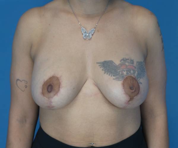 after breast lift with augmentation front view case 3923