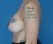 after breast lift with augmentation left side view case 3923