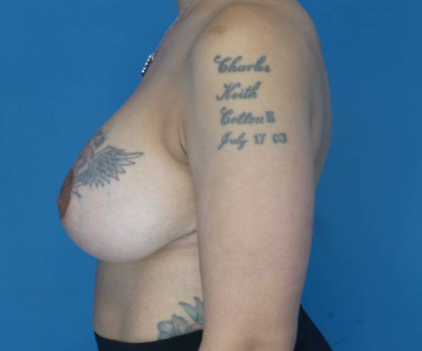 after breast lift with augmentation left side view case 3923