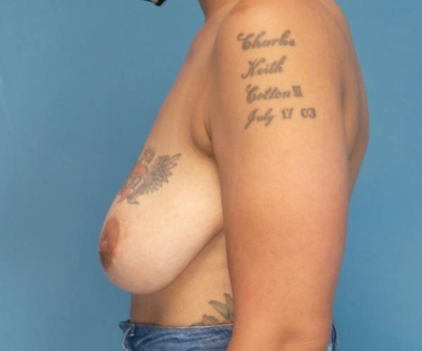 before breast lift with augmentation left side view case 3923