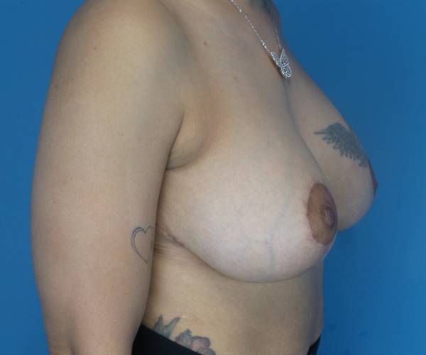 after breast lift with augmentation right side view case 3923