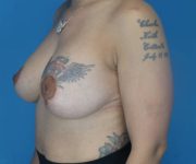 after breast lift with augmentation left angled view case 3923