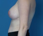 after breast lift with augmentation left view case 3964 | Crispin Plastic Surgery Atlanta, GA