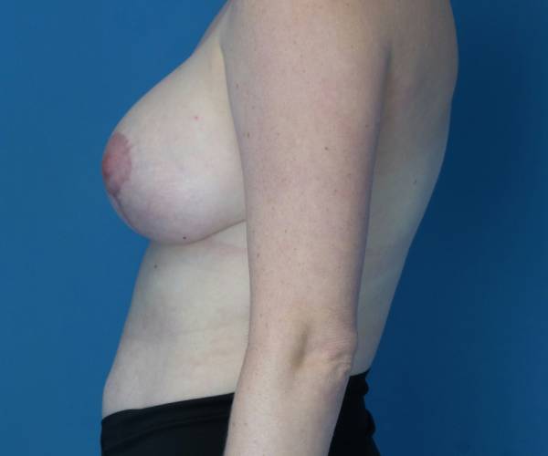 after breast lift with augmentation left view case 3964 | Crispin Plastic Surgery Atlanta, GA