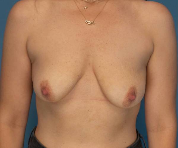 before breast lift with implants front view female patient case 3980