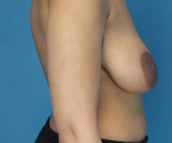 before breast lift with augmentation front right view case 3250 | Crispin Plastic Surgery Atlanta, GA