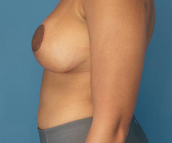 after breast lift with augmentation front left view case 4000 | Crispin Plastic Surgery Atlanta, GA