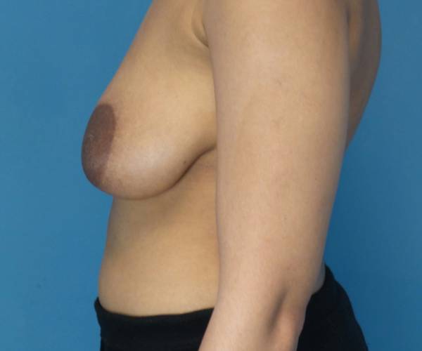 before breast lift with augmentation front left view case 4000 | Crispin Plastic Surgery Atlanta, GA