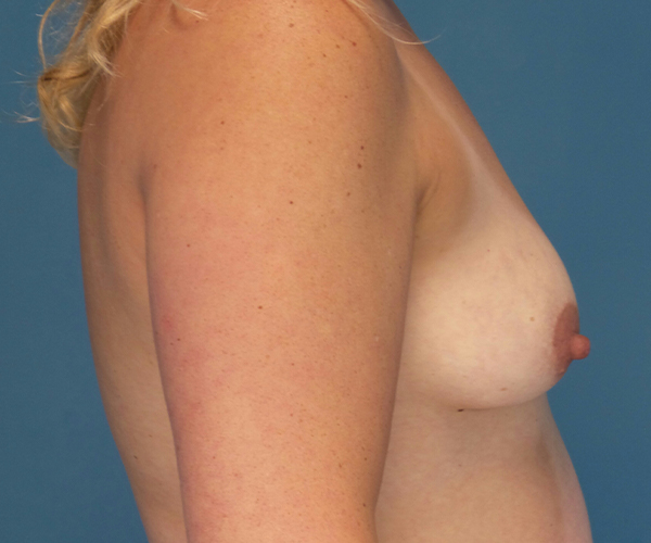 before breast lift with augmentation right view case 3991 | Crispin Plastic Surgery Atlanta, GA
