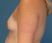 before breast lift with augmentation left view case 3991 | Crispin Plastic Surgery Atlanta, GA