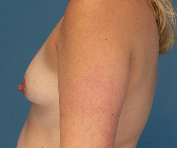 before breast lift with augmentation left view case 3991 | Crispin Plastic Surgery Atlanta, GA