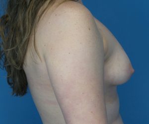 before breast lift with augmentation right view case 3973 | Crispin Plastic Surgery Atlanta, GA