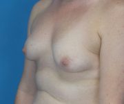 before breast lift with augmentation left diagonal view case 3973 | Crispin Plastic Surgery Atlanta, GA