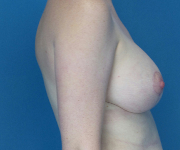 after breast lift with augmentation right view case 3964 | Crispin Plastic Surgery Atlanta, GA