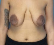 before breast lift with augmentation front view case 4000 | Crispin Plastic Surgery Atlanta, GA