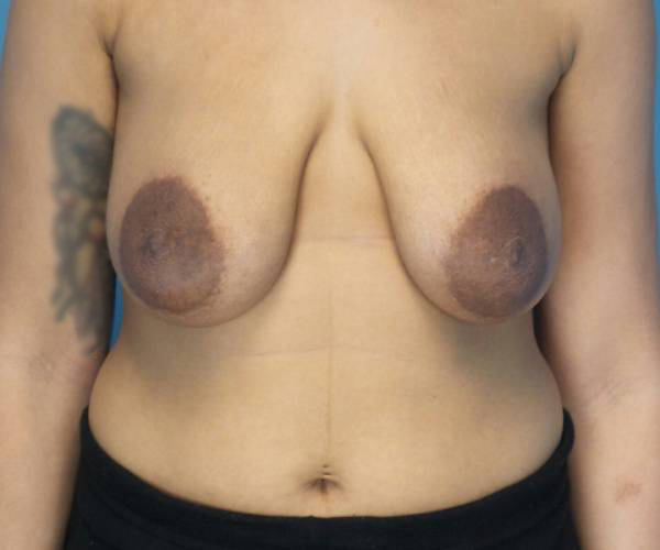 before breast lift with augmentation front view case 4000 | Crispin Plastic Surgery Atlanta, GA
