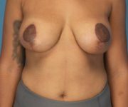 after breast lift with augmentation front view case 4000 | Crispin Plastic Surgery Atlanta, GA
