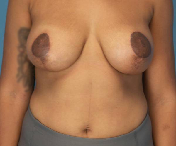 after breast lift with augmentation front view case 4000 | Crispin Plastic Surgery Atlanta, GA