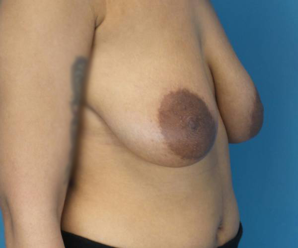 before breast lift with augmentation front right diagonal view case 4000 | Crispin Plastic Surgery Atlanta, GA