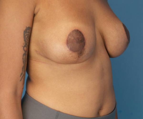 after breast lift with augmentation front right diagonal view case 4000 | Crispin Plastic Surgery Atlanta, GA