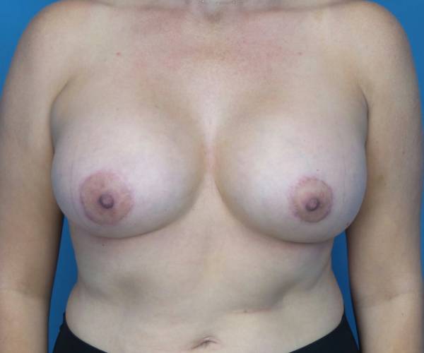 after breast lift with augmentation front view case 3250 | Crispin Plastic Surgery Atlanta, GA